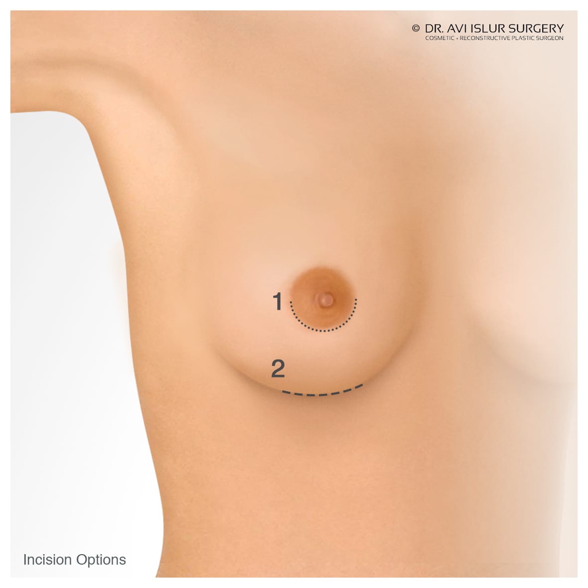 First Glance Aesthetic Clinic Breast Augmentation