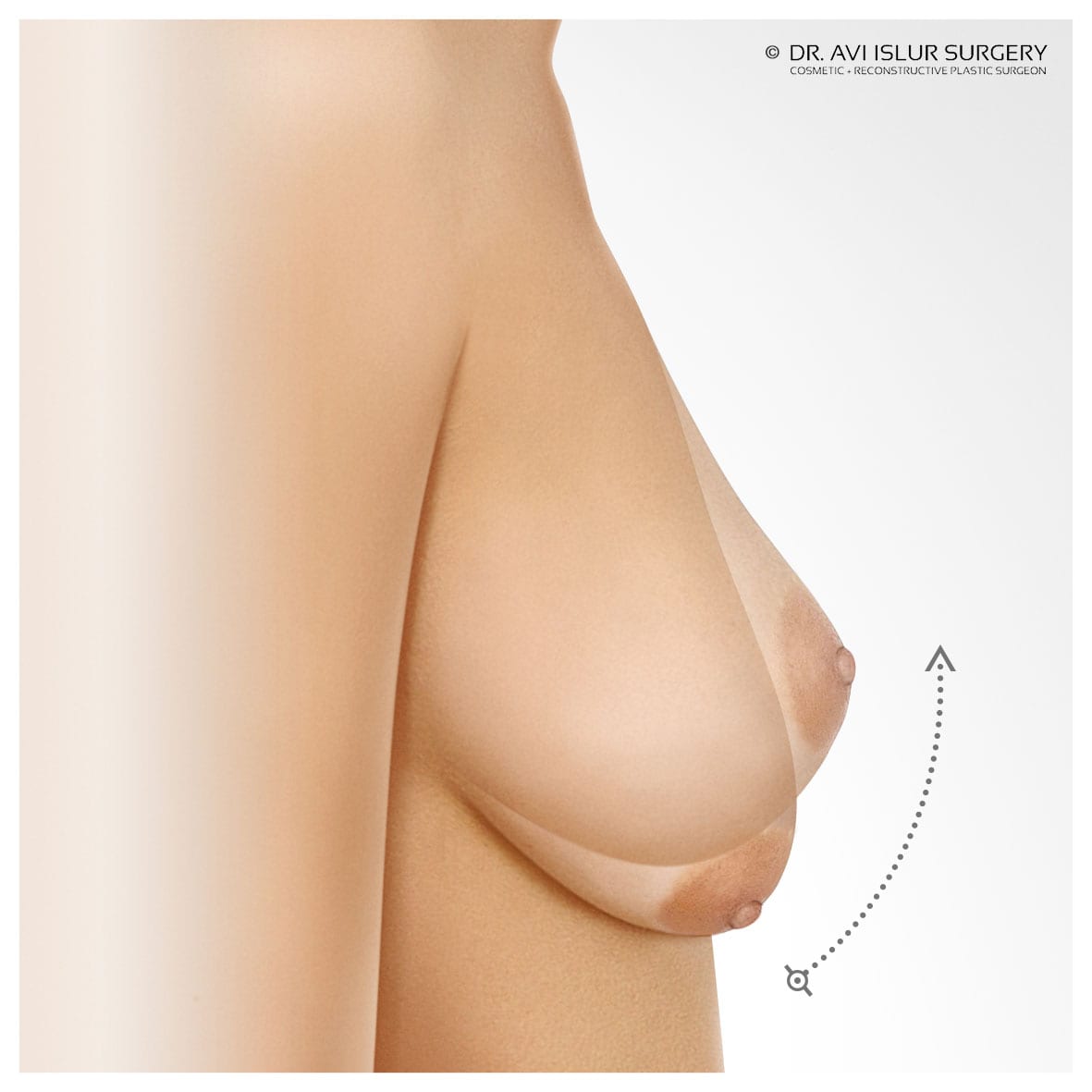 First Glance Aesthetic Clinic Breast lift