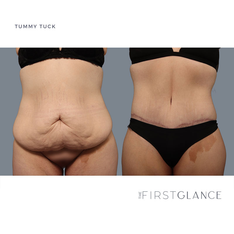 Tummy Tuck - The First Glance