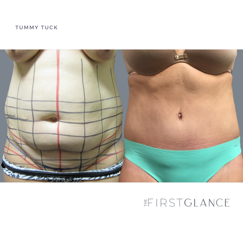 FirstGlance-TummyTuck-Case2-1