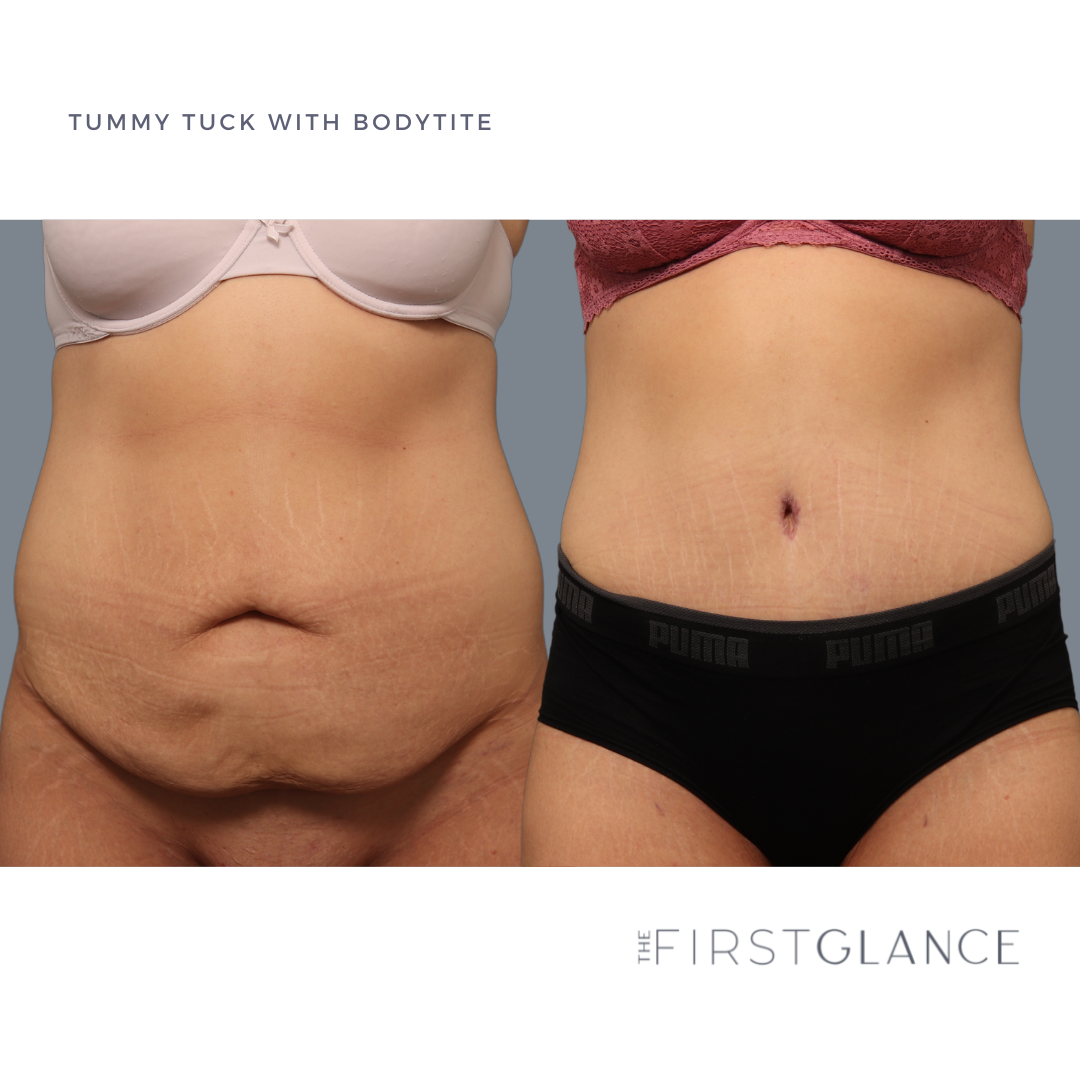 FirstGlance-TummyTuck-Case3-1