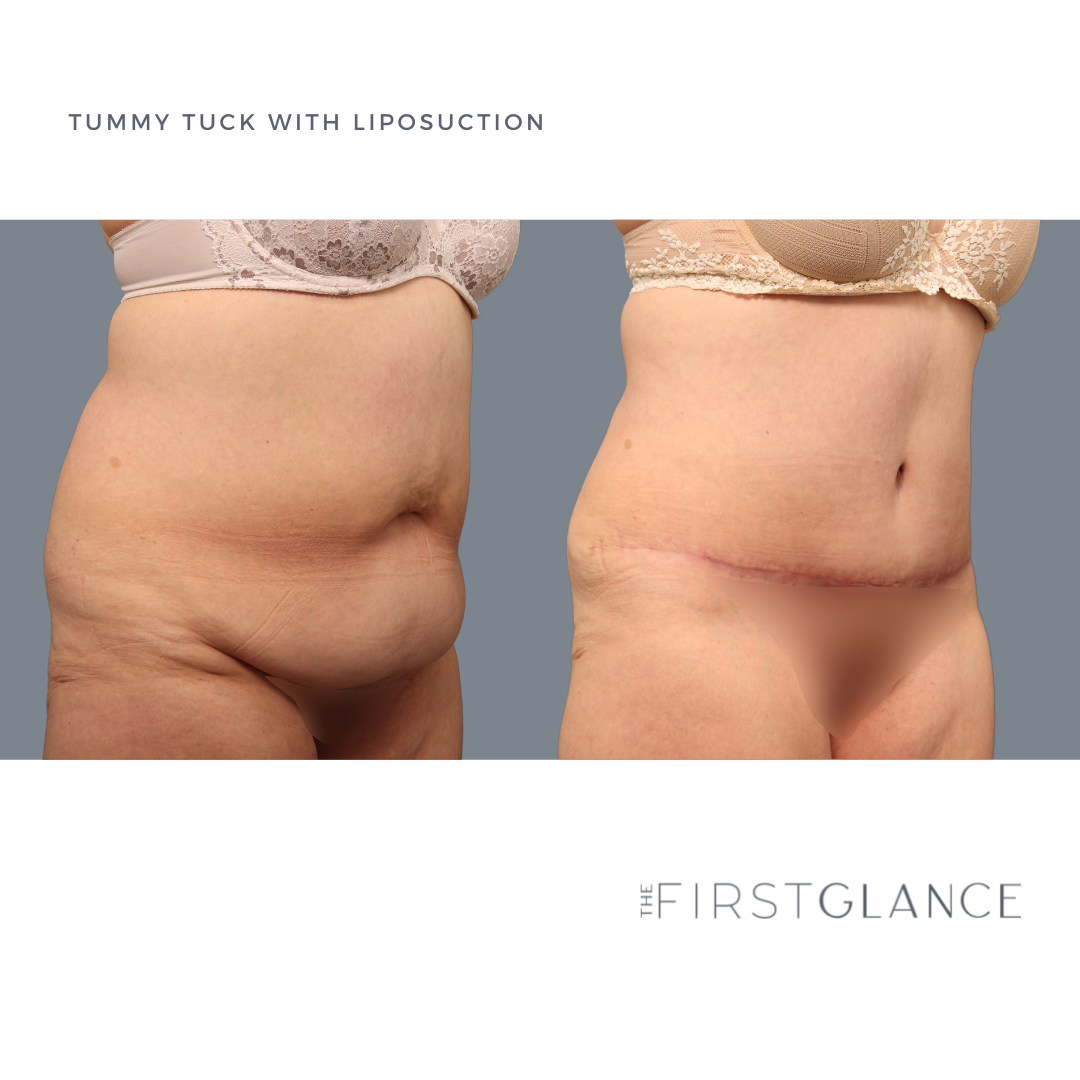 FirstGlance-TummyTuck-Case5-3