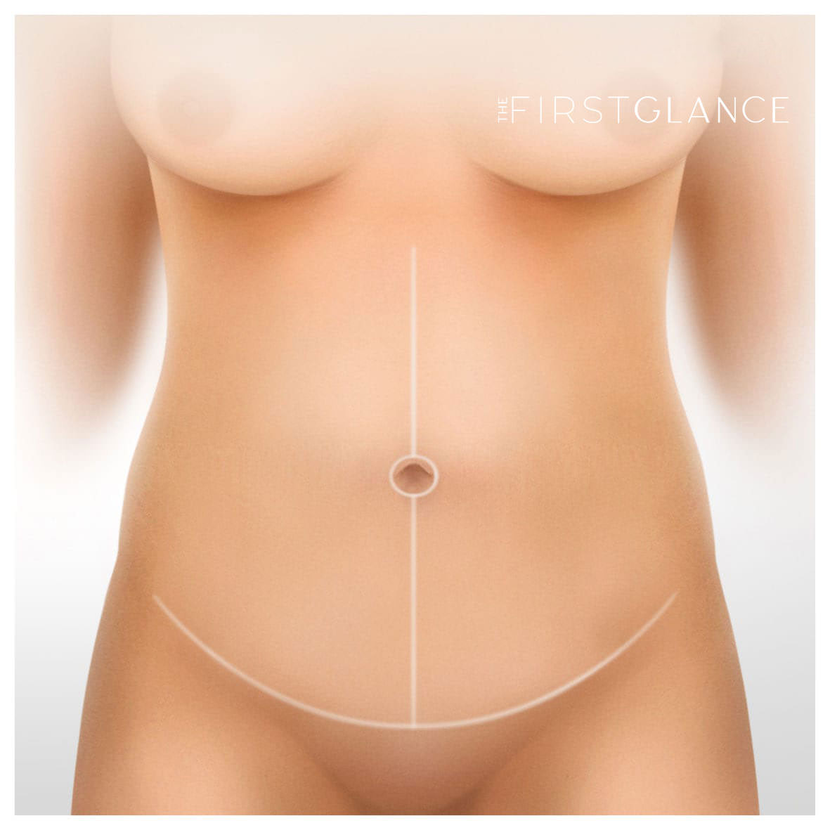 First Glance Aesthetic Clinic Fleur De Lys Tummy Tuck after