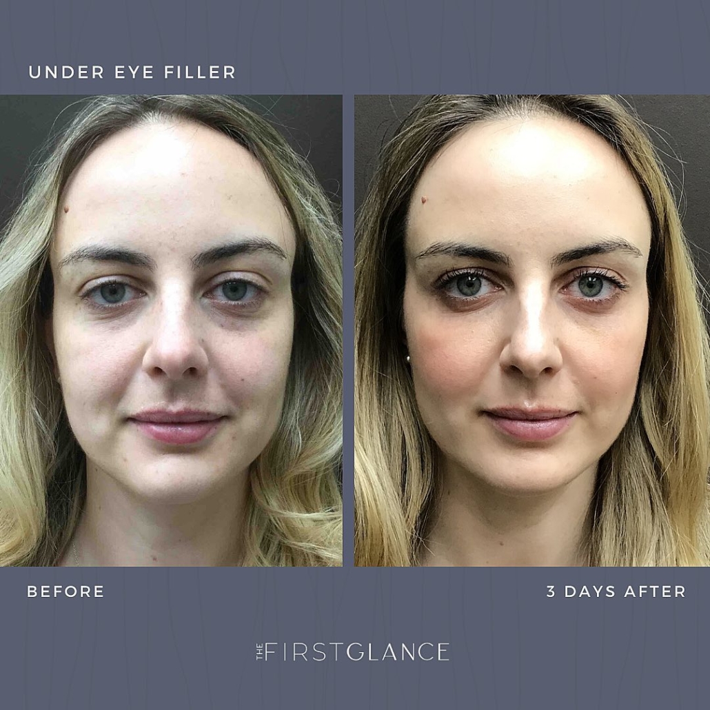 First Glance Aesthetic Clinic Under Eye Fillers