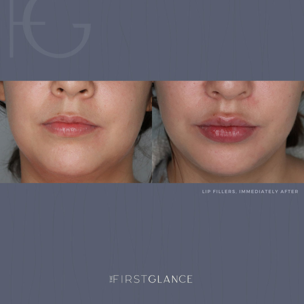 First Glance Aesthetic Clinic Lip Fillers