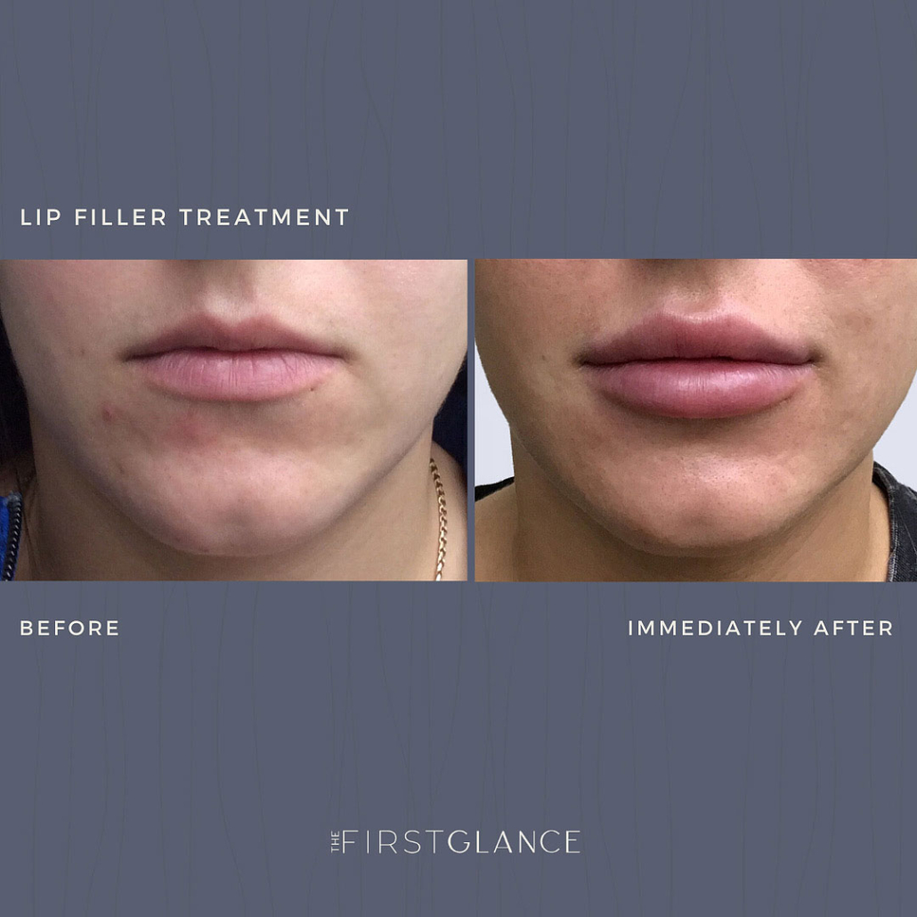 First Glance Aesthetic Clinic Lip Fillers